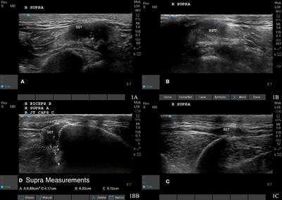Case study: Treating infraspinatus and supraspinatus trigger points and supraspinatus tendinopathy utilizing piezoelectric shockwave
